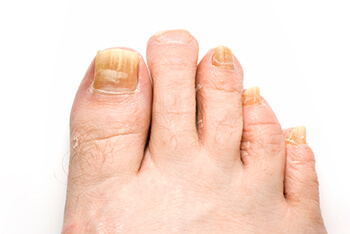 Fungal toenails diagnosis and treatment in the E Norwich, NY 11732, Franklin Square, NY 11010 and Oceanside, NY 11572 areas