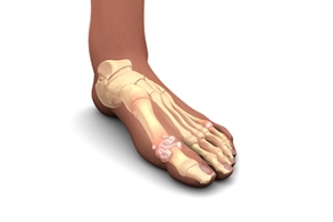 Can Gout Affect Children and Teenagers?