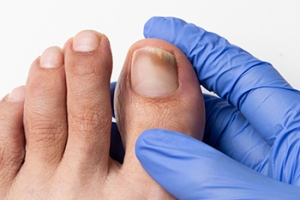 Chemotherapy and Toenail Fungus